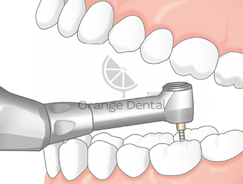 Эндомотор Endo-Mate TC2 - беспроводной  с миниатюрной головкой MP-F16R NSK | NSK Nakanishi (Япония)